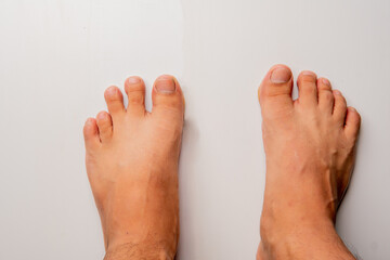Male foot with shortest fourth toe. Brachymetatarsia Morton's foot, Greek foot, royal toe, peacock toe, Sheppard's toe, Viking toe, Morton's syndrome, long toe or boss toe, image for medical use.