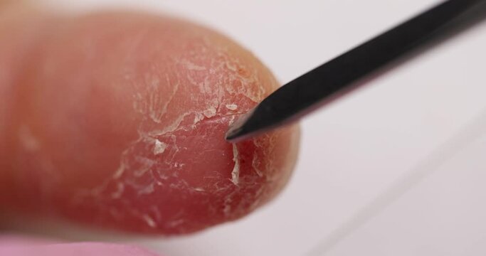 Closeup of finger with peeling skin and doctor takes scraping