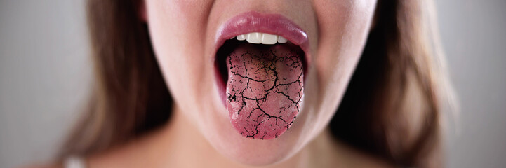 Dry Tongue Pain And Cracks