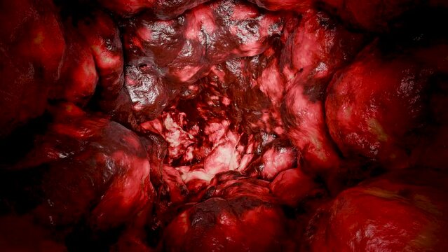 Colorectal cancer, malignant tumor in intestine, Endoscope inside colonoscopy, gut intestine, Colon polyp removal, inflammatory bowel Disease,  intestinal carcinoma, bowel neoplasia, 3d render