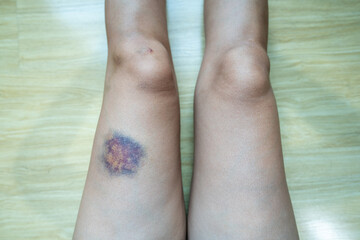 Bruises on women's legs, accident.