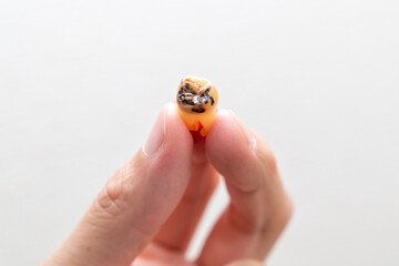 虫歯になった人の永久歯の写真。抜歯された親知らずの虫歯の写真。