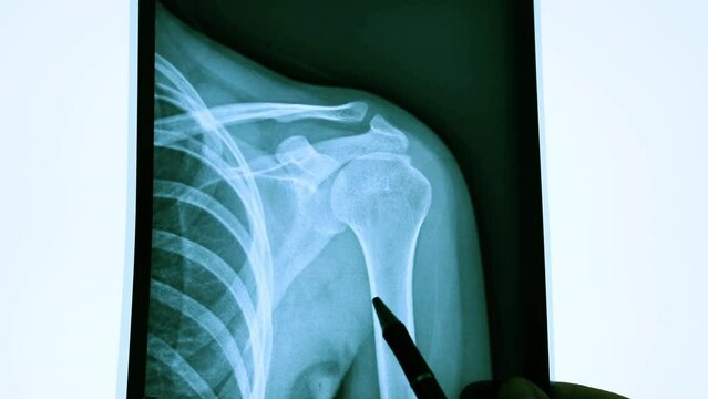 X-ray Scan a Healthy Shoulder Medical Diagnosis Doctor Analyzing a Damaged Bone 4k