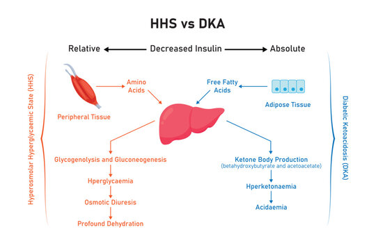 Hyperosmolar Hyperglycemic State (HHS) and Diabetic Ketoacidosis (DKA) Scientific Design. Vector Illustration.