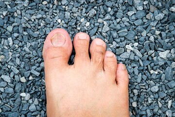 Lines are deep grooved on toenail caused by lack of vitamin, calcium or onychomycosis or brittle...