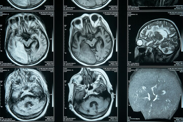 MRI imaging, diagnosis and treatment of brain diseases