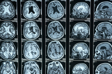 MRI images of the brain show different slices and structures of the brain. Diagnosis and treatment...