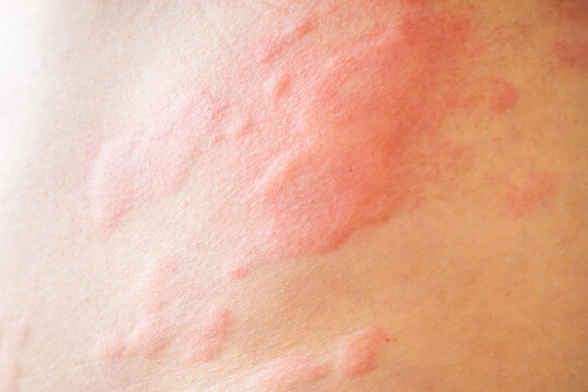 Skin allergy rash dermatitis texture close up background