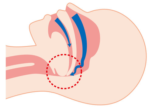 睡眠時無呼吸症候群のメカニズム