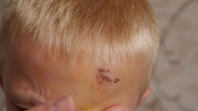 A close-up of a caring mother applying ointment to a scratch and a bump on her little son's forehead.
