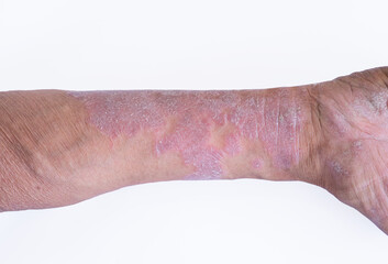 Skin disease psoriasis