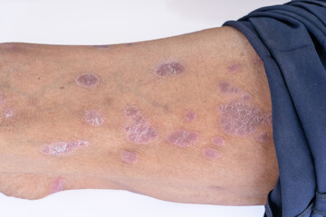 Skin disease psoriasis