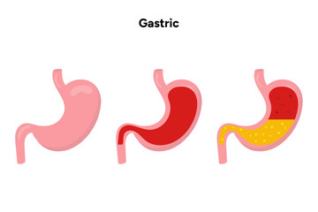 Gastritis, stomach problem