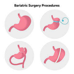 Bariatric surgery procedures