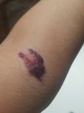 needlestick injury