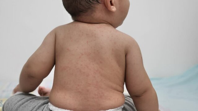 Baby girl with red rash on her skin, measles or chicken pox on newborn