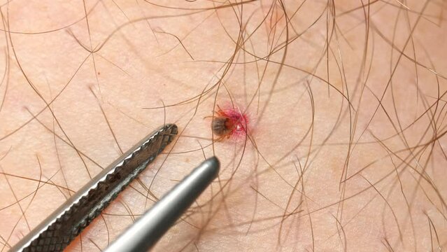 Close-up view of tick being removed from human skin with tweezers, depicting careful process of tick removal. Precaution and safety during outdoor activities.