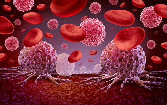 Leukemia and Cancer in the blood outbreak and treatment for malignant cells in a human body caused by carcinogens and genetics with a cancerous cell as an immunotherapy or lymphoma symbol and oncology