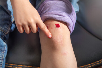  Kid with injured knee and wound.