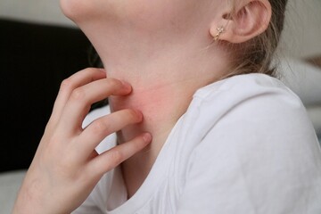 The child scratches atopic skin. Dermatitis, diathesis, allergy on the child's face.	 - obrazy, fototapety, plakaty