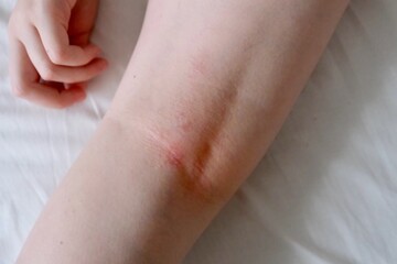 The child scratches atopic skin. Dermatitis, diathesis, allergy on the child's leg
