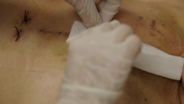 doctor is bandaging of patient after cleaning the wound from heart surgery (Heart Valve Regurgitation)

