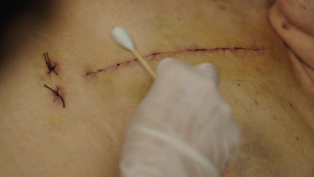 doctor using alcohol and cotton bud cleaning wound from open heart surgery on the female body (Heart Valve Regurgitation)