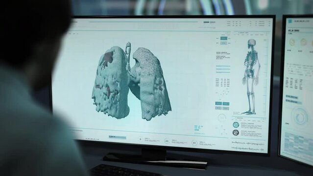 Doctor supervises computer interface analysis of the cancer patient lungs. Doctor is inspecting lung with cancer using modern interface. Doctor searches for cancer treatment using software interface.