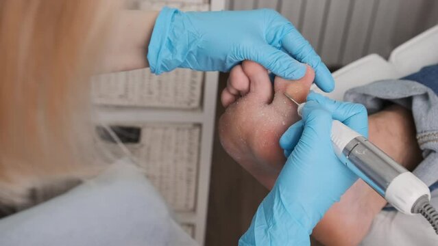 A callus on a womans foot is removed by a podologist using an electric drill at the clinic.