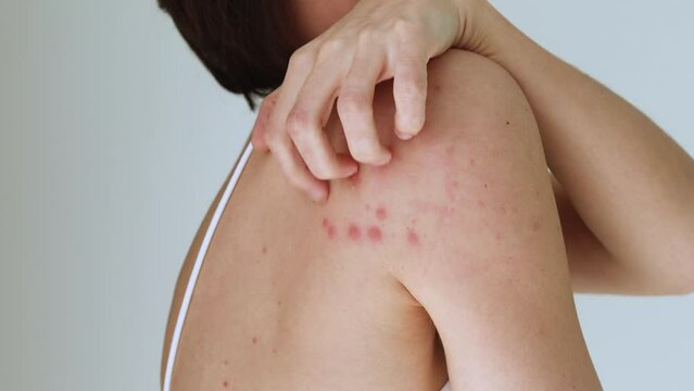 A woman scratches her shoulder bitten by a bedbug on a white background, close-up. Skin health problem. Red pimples.