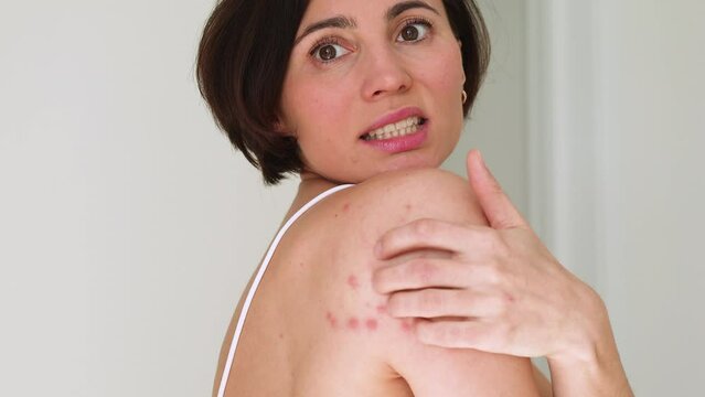 A woman scratches her shoulder bitten by a bedbug on a white background, close-up. Skin health problem. Red pimples.