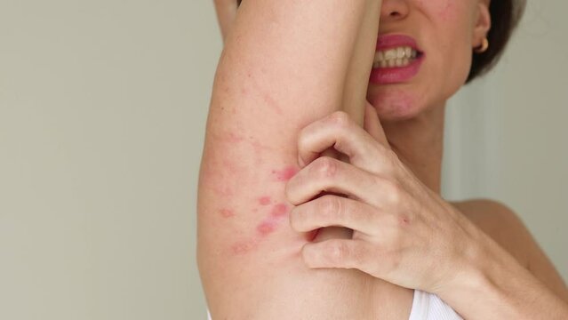 A woman scratches her shoulder bitten by a bedbug on a white background, close-up. Skin health problem. Red pimples.