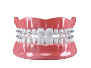 a model of teeth with braces