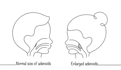 Adenoids
