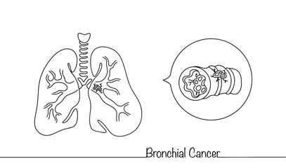 Bronchial cancer