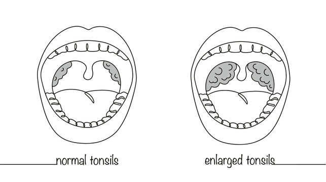 Palatine tonsils