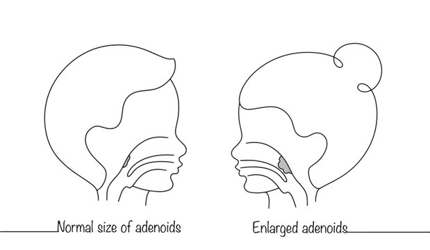 Adenoids