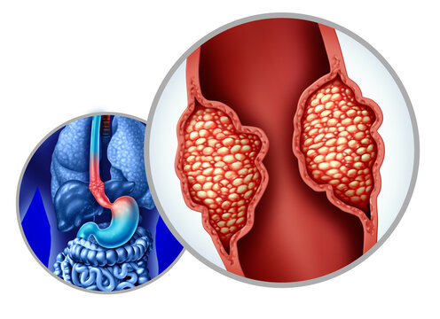 Esophageal Cancer or esophagus Carcinoma as Adenocarcinoma mutating cell growth inside the digestive system as a growing tumor close up.