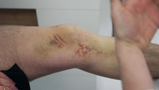 Doctor's hand gesticulate near the patient's leg with some bruises on. Surgeon explains the future operation on traumatized knee. Close up.