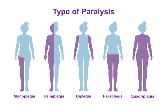 Paralysis types, spinal cord injury. Stroke, tumor, nerve damage brain. Face palsy.