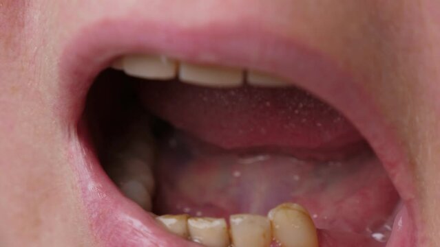 Unrecognizable woman with bad broken teeth. Female mouth with damaged and cracked tooth. Closeup