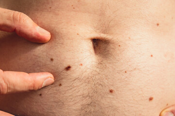 Unrecognizable man showing his birthmarks on skin Close up detail of the bare skin Sun Exposure...