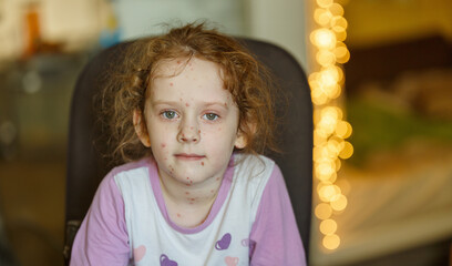 Portrait a sad little girl with chickenpox at new year home interior. Varicella virus.