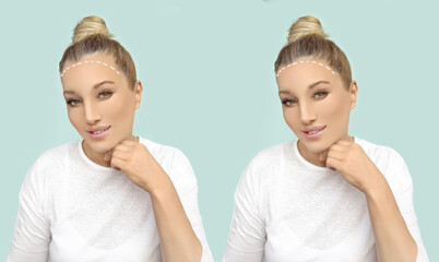 Thinning hair and hair loss,female pattern baldness,Hair transplant