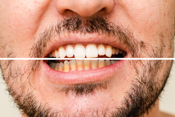 Man's teeth before and after whitening and alignment (braces). Oral care