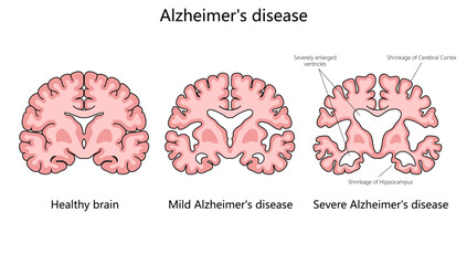 progression of Alzheimer disease, comparing a healthy brain to those with mild and severe Alzheimer structure diagram hand drawn schematic vector illustration. Medical science educational illustration