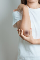 Bruise, wound and Contusion concepts. Woman having bruised on Elbow and Arm due to accident. Skin...
