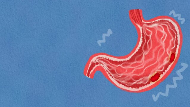 Peptic Ulcer Disease Cartoon Animation Background : Hand painting style 