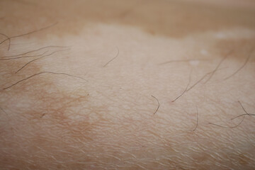  feet with vitiligo skin condition.