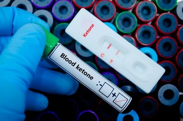 Blood sample of patient positive tested for blood ketone by rapid diagnostic test